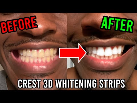 Using Crest 3D Whitestrips in 2022 *Honest Review* | How to Whiten Yellow Teeth