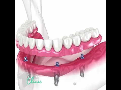 All-on-4 & All-on-6 Full Arch Dental Implants - Surgical Procedure - One Clinic Patient Review Video