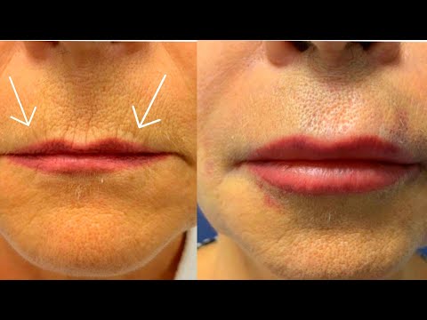 How to Get Rid of Wrinkles around Lips????How to Get Plump Lips/Bigger/Lips/Fuller Lips