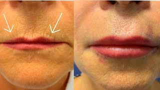 How to Get Rid of Wrinkles around Lips💋How to Get Plump Lips/Bigger/Lips/Fuller Lips