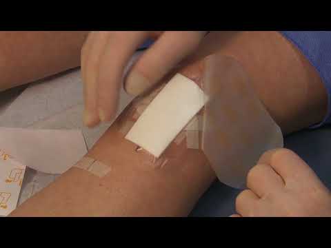 Zakładanie opatrunku po zabiegu artroskopowym kolana 
