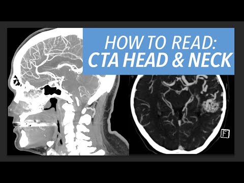 How to Read a CTA of the Head & Neck: An Approach for Beginners