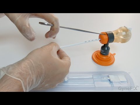 Einlage der Kupferkette Gynefix als hormonfreie Verhütung in Berlin - Frauenärzte am Potsdamer Platz