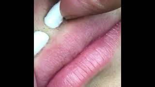 Ultimate Pimple Popping Compilation | Deep Cyst Removal & More!