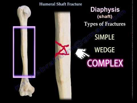 Humeral Shaft Fracture - Everything You Need To Know - Dr. Nabil Ebraheim