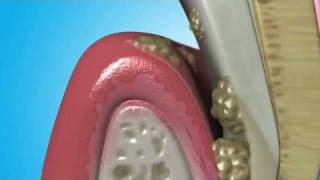Treatment for Gum Disease