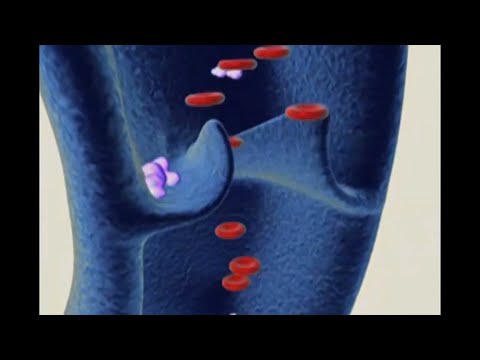 Como ocorre a trombose venosa e a embolia pulmonar?