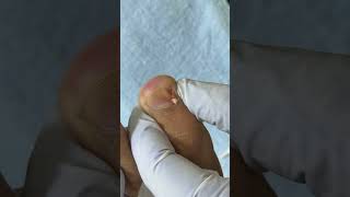 Ep_8290 Foot nails skin removal 👣 ไม่เจ็บ..แต่คันมากค่ะ 😄 (clip from Thailand)