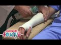 Getting A Cast For A Broken Bone Clip TV Show For Kids Operation Ouch