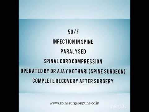 Advanced Spine Surgery | Dr. Ajay Kothari
