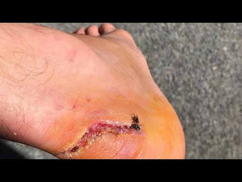 The unrivaled #healing power of #noni