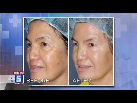 Laser Treatments for Eyelids, Birthmarks, Brown Spots, & Acne