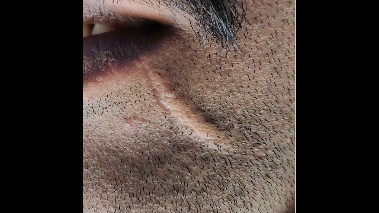 Making Scars Less Noticeable with Scar Revision - Before & After pics