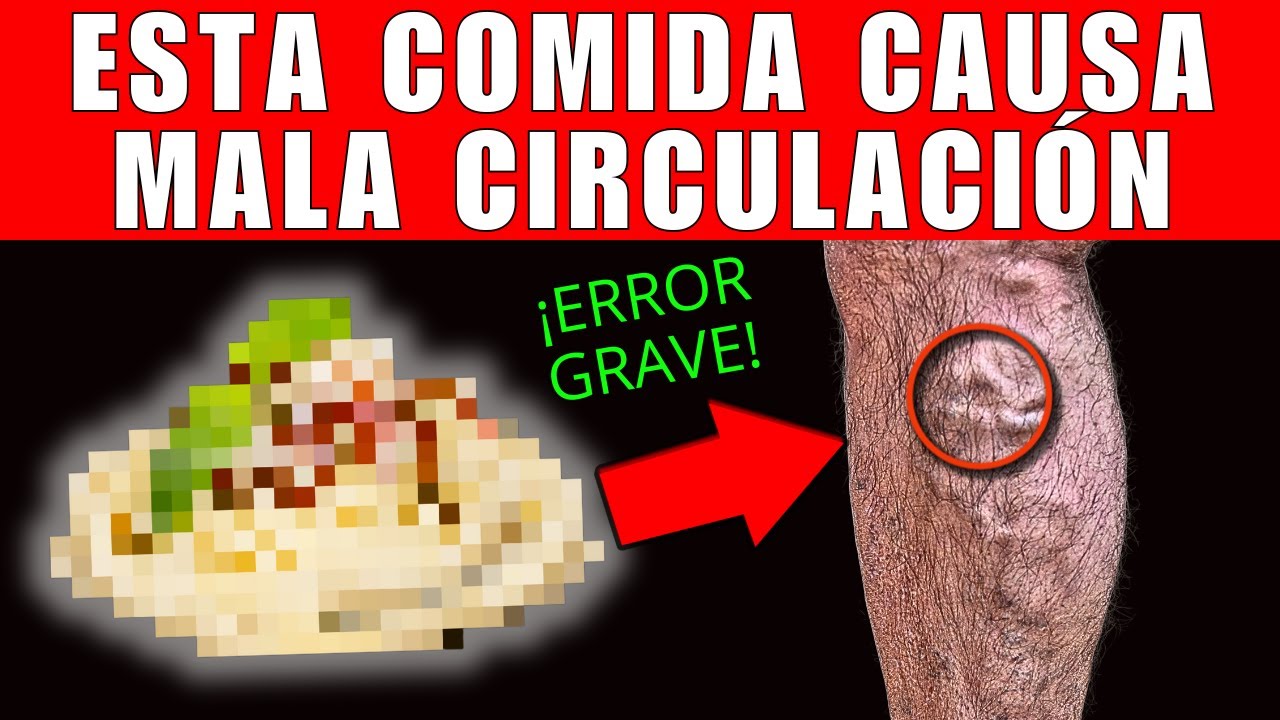 7 ALIMENTOS que CAUSAN INSUFICIENCIA VENOSA y VARICES