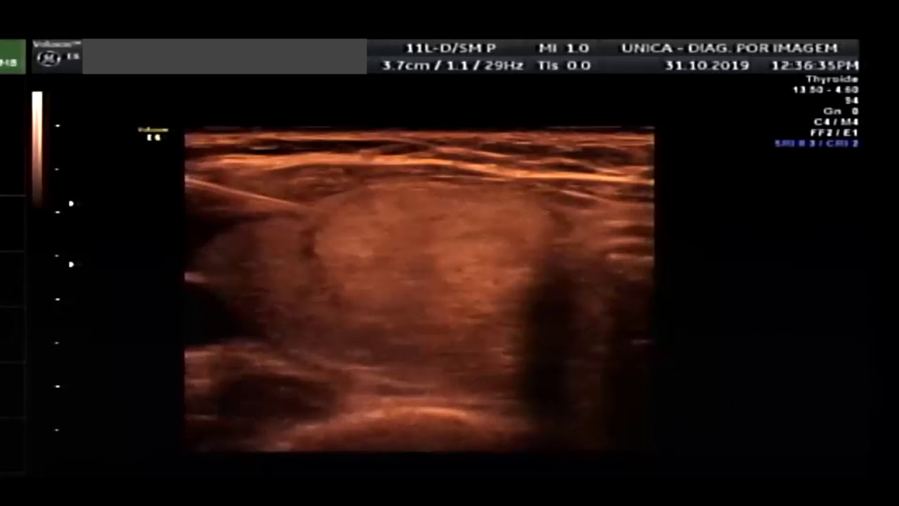 PUNÇÃO OU PAFF DE TIREOIDE