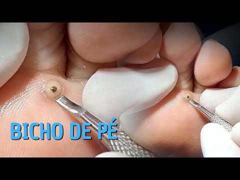 PERIGOSO: Bicho-de-Pé sendo removido e o que tinha dentro É SURPREENDENTE! Havia…Ver mais