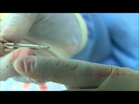 How A Follicular Unit Extraction (FUE) Procedure is...