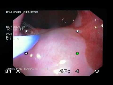Esophageal Carcinoma In Situ - Endoscopic Resection