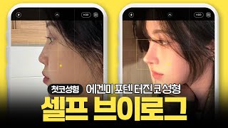 2D에서 3D로 입체감 상승한 #코성형 ㄹㅇ 찐 후기