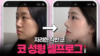직반 #코성형 후기 근데 자려함을 곁들인