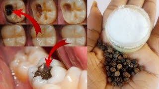 Cure tooth cavity just in one day || 100% effective remedy for tooth ache ( tooth pain home remedy )
