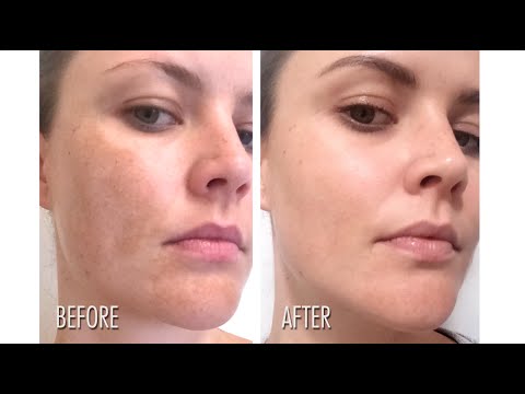 La decolorazione di crema in letual Il pigmentary nota su mani di faccia della ragione e il trattamento