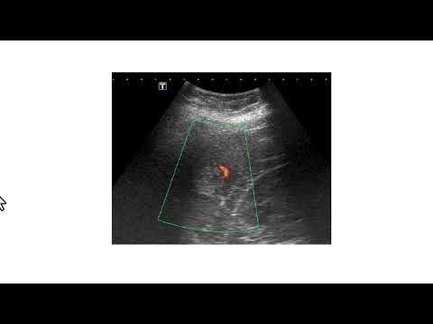 Achados clínicos, ultrassonográficos e tomográficos típicos dos hemangiomas hepáticos