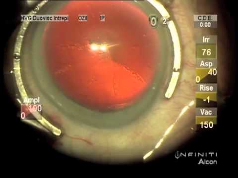 CCC capsulorhexis à l'aide d'un cystotome