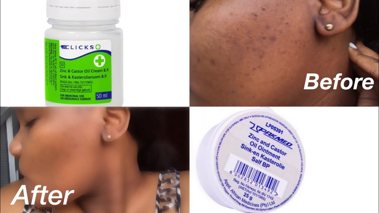 Watch video Zinc and Castor oil for dark spots review| Does it work Now Zinc and Castor oil for dark spots review| Does it work