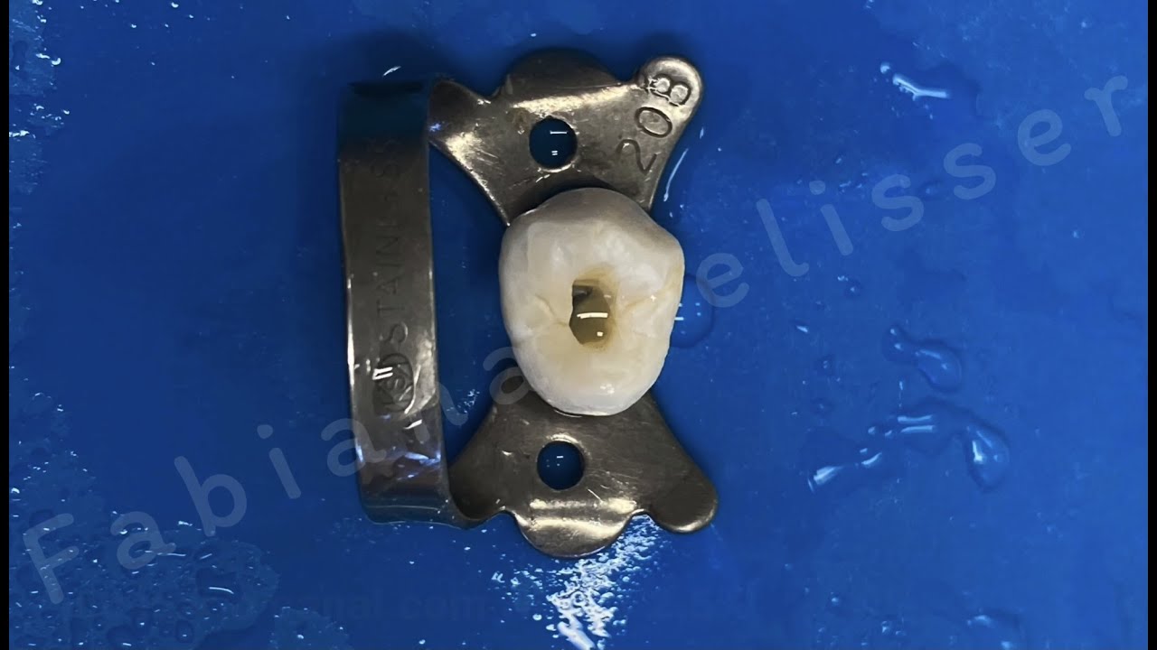 Abertura coronária pré-molar superior - Professora Fabiana Vier Pelisser