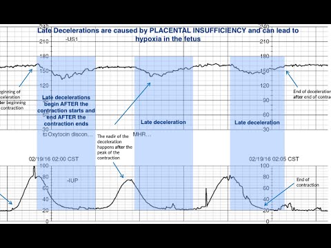 Fetal Monitoring Part 3: Understanding Late Decelerations