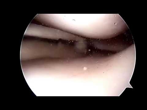 Mexidol iniezioni in osteocondrosi della colonna cervicale Una tazza per giunti