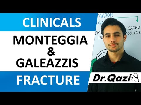 Monteggia and Galeazzi Fracture| Smiths and Colle's Fracture | Forearm Fractures