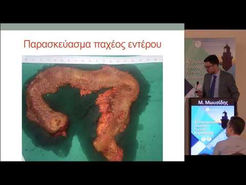 Μ. Μωυσίδης - Πολλαπλά GIST λεπτού εντέρου σε ασθενή με AFAP