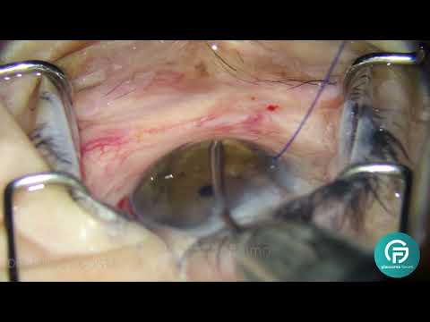 Video educativo de Glaucoma Forum en YouTube