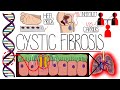 Understanding Cystic Fibrosis Includes Pathophysiology Diagnosis