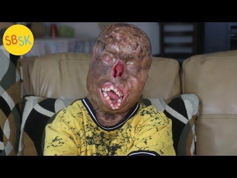 Surviving Severe Burns (Doctors Say He’s a Miracle)