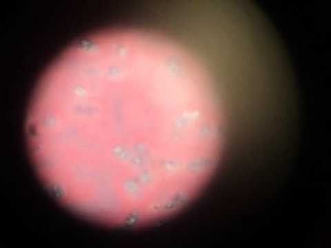 Benda per il ginocchio malattia di Osgood-Schlatter Mal di schiena dopo un mese e grassa
