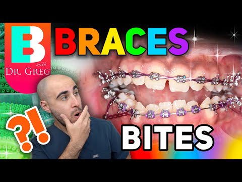Braces Overbite, Overjet, Underbite, Crossbite & Open Bite Explained!