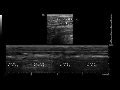 PoCUS Lung - Pneumothorax/Lung Point
