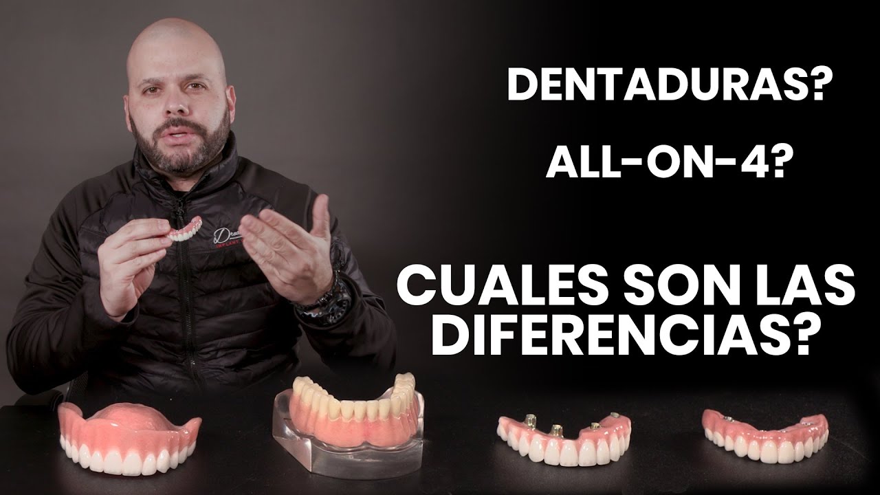 Dentaduras vs Sobre Dentaduras vs All-on-4 Implantes Dentales