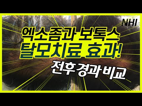 엑소좀과 보톡스 탈모치료의 효과 (feat. 최신 탈모치료)｜뉴헤어