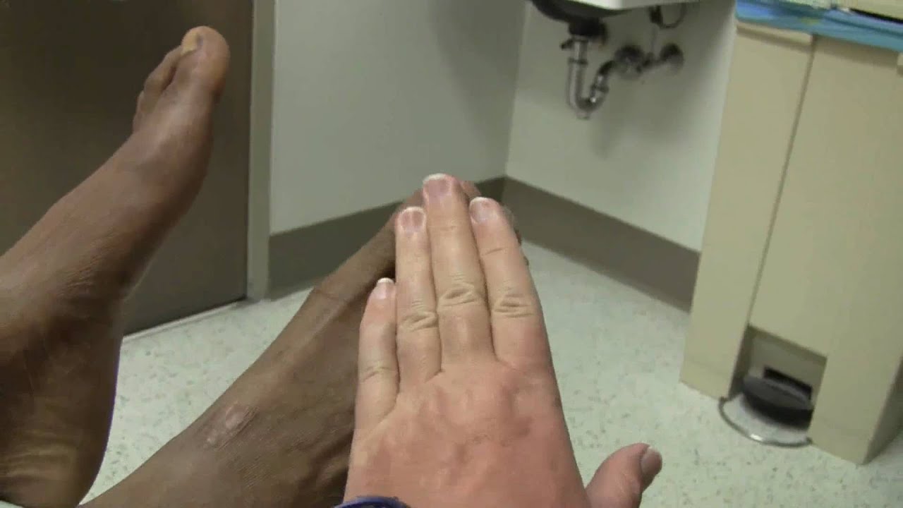 Foot Drop and Peroneal Nerve Injury - YouTube
