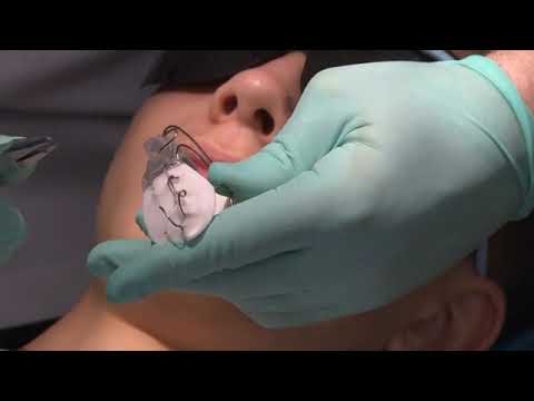 Dopasowanie aparatu ortodontycznego - Bionator