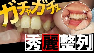 【セラミック矯正】劇的3症例！前歯のガチャガチャ歯並び改善サムネイル