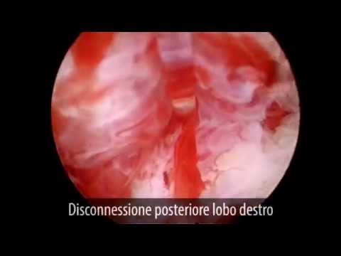 Fare stretching utile per la prostata Di essere trattati prostata