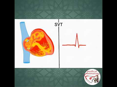NORMAL CARDIAC RHYTHM & SVT