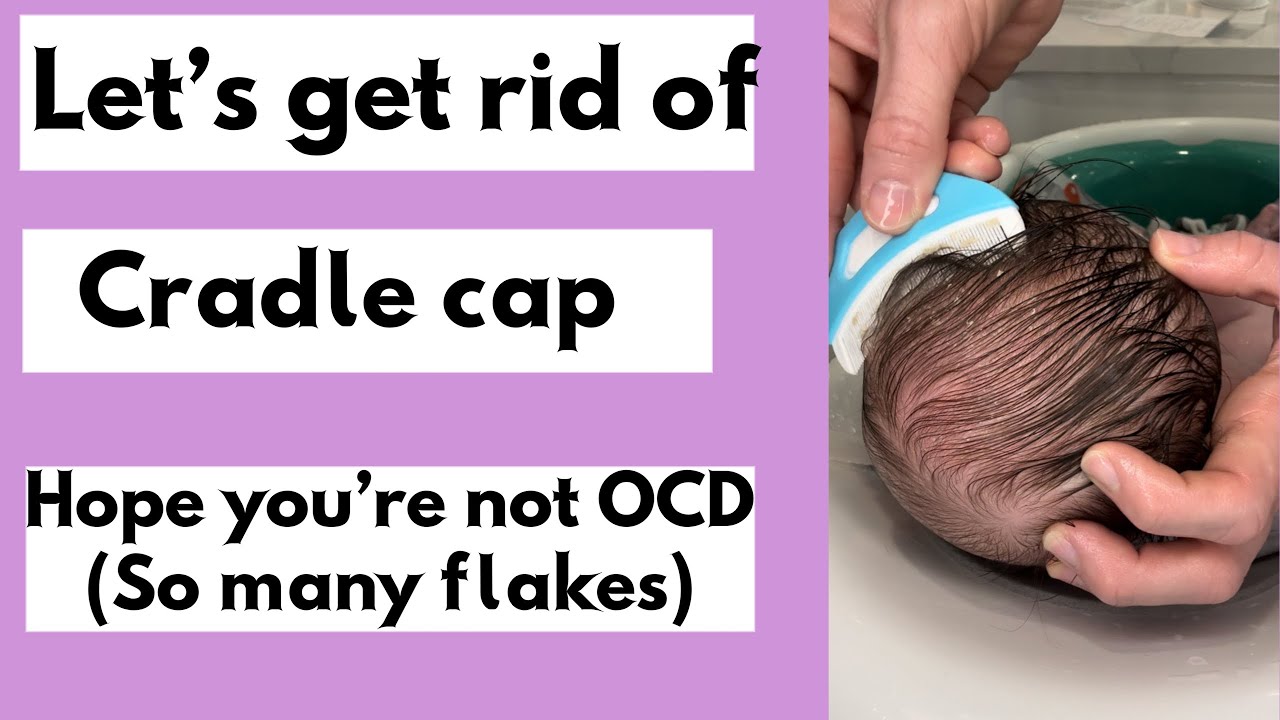Cradle cap (how to remove flakes) using Frida Baby remover