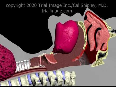 Endotracheal Intubation Animation by Cal Shipley, M.D.