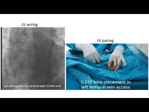 Portico TAVI : No RV pacing